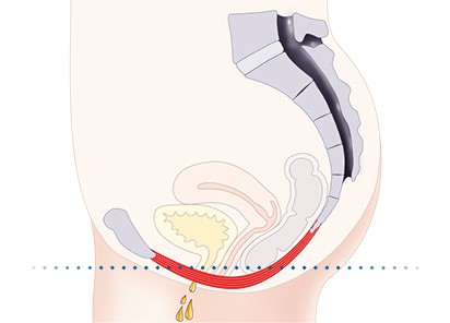 Pelvic-Floor Muscle Repair 5 Pelvic floor muscles Wrexham